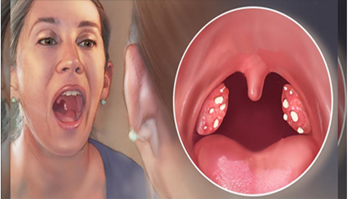 У вас часто болит горло, пропадает голос и мучает кашель? Вот как ...